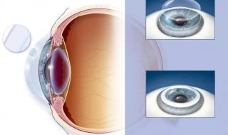 icl人工晶体植入手术 icl人工晶体植入手术